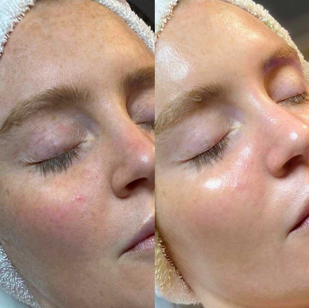 What Is The Difference Between HydraFacial And Microdermabrasion Beautifeyes Studio